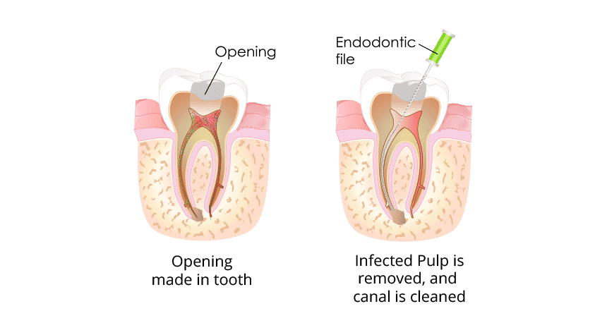 How Root Canal Treatment Can Save a Tooth - Marion Family Dental